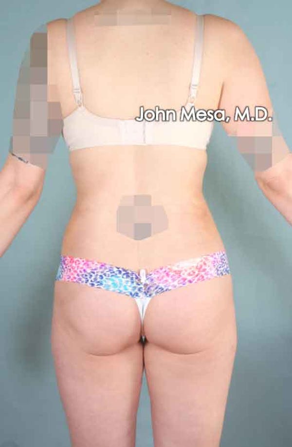 Liposuction Before & After Gallery - Patient 6371511 - Image 6