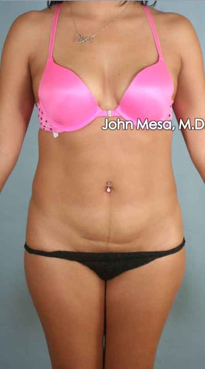 Liposuction Before & After Gallery - Patient 6371517 - Image 1