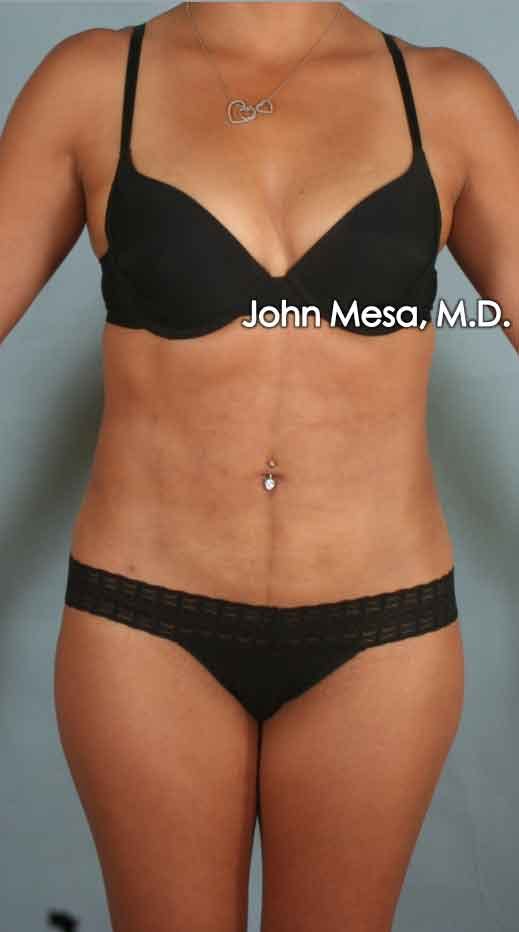 Liposuction Before & After Gallery - Patient 6371517 - Image 2