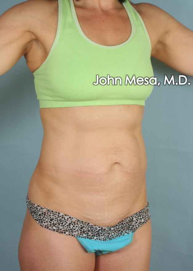 Panniculectomy Before & After Gallery - Patient 6371520 - Image 1