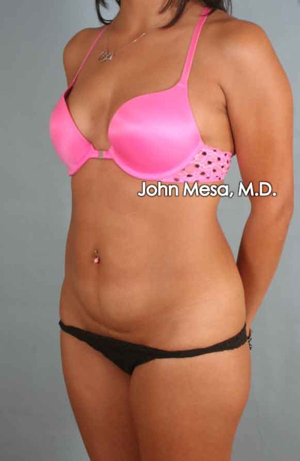Liposuction Before & After Gallery - Patient 6371517 - Image 3
