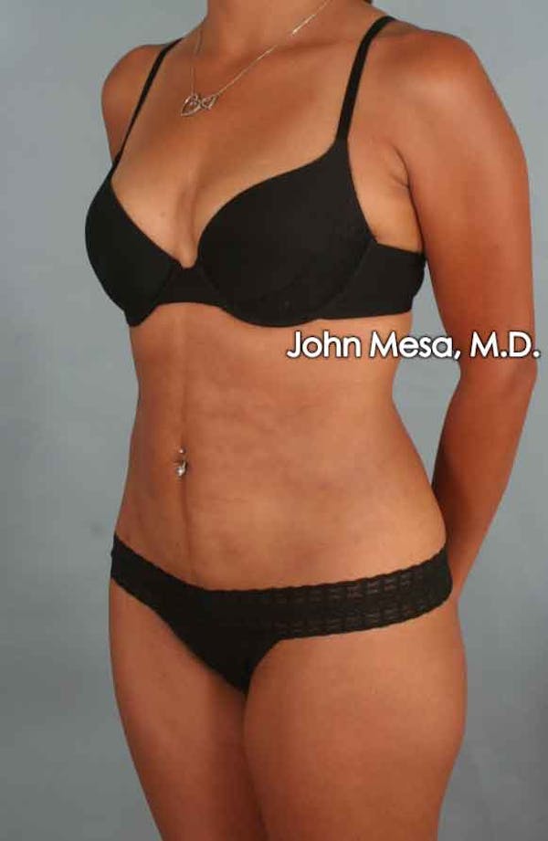 Liposuction Before & After Gallery - Patient 6371517 - Image 4