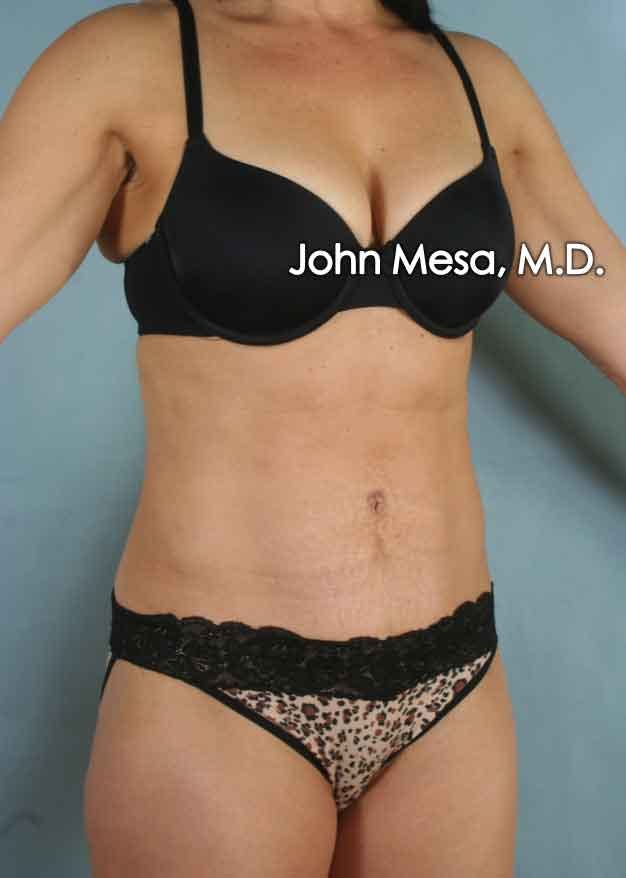Panniculectomy Before & After Gallery - Patient 6371520 - Image 2