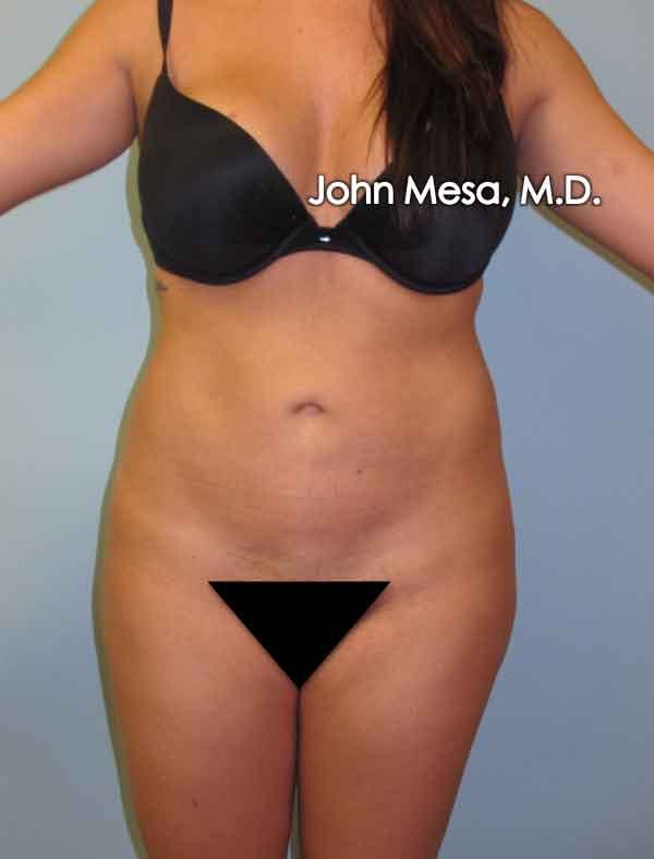 Liposuction Before & After Gallery - Patient 6371518 - Image 1