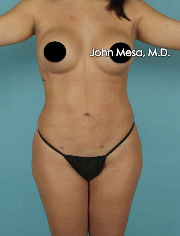 Liposuction Before & After Gallery - Patient 6371518 - Image 2