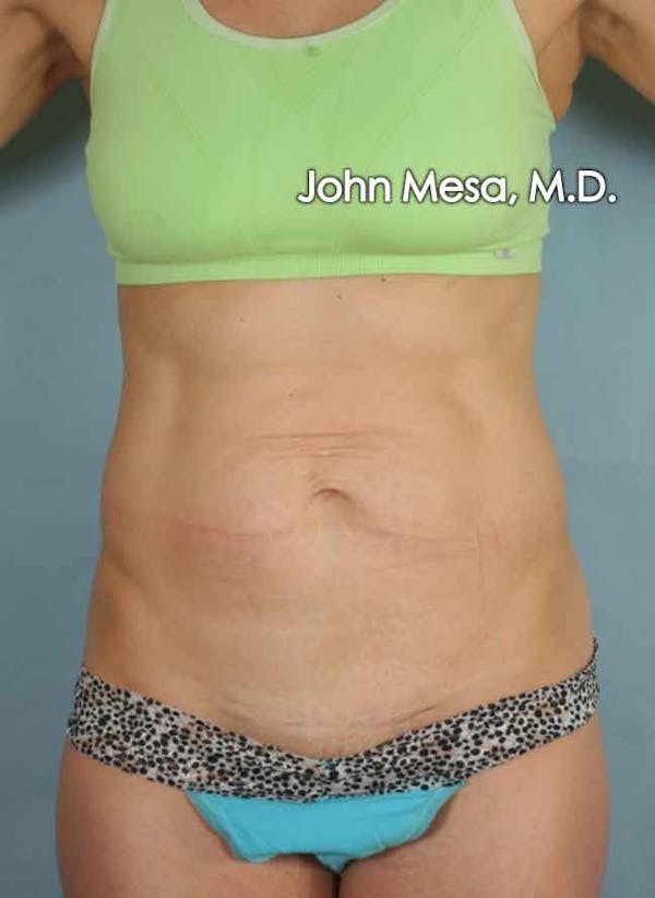 Panniculectomy Before & After Gallery - Patient 6371520 - Image 5