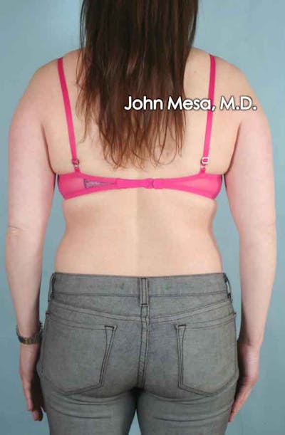 Liposuction Gallery - Patient 6371522 - Image 1
