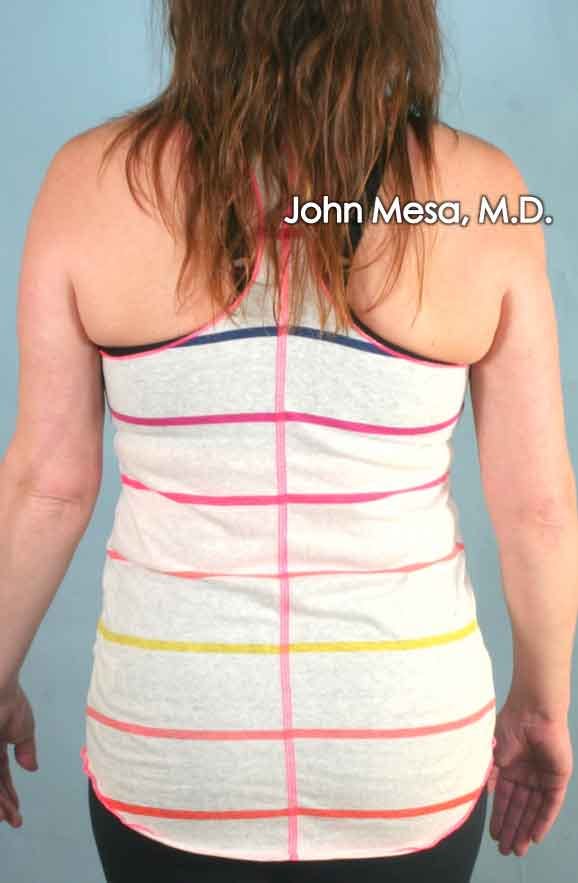 Liposuction Before & After Gallery - Patient 6371522 - Image 2
