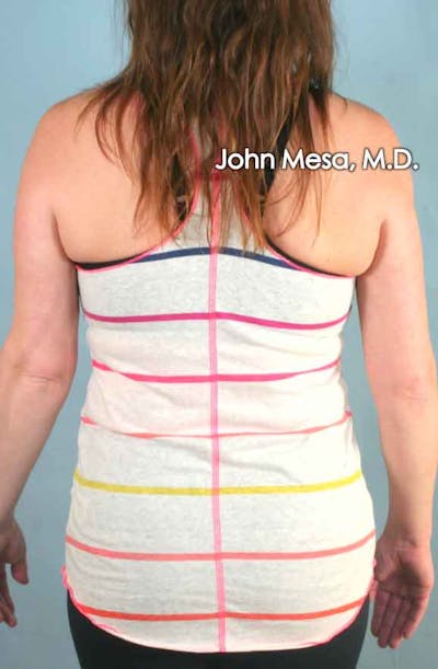 Liposuction Before & After Gallery - Patient 6371522 - Image 2