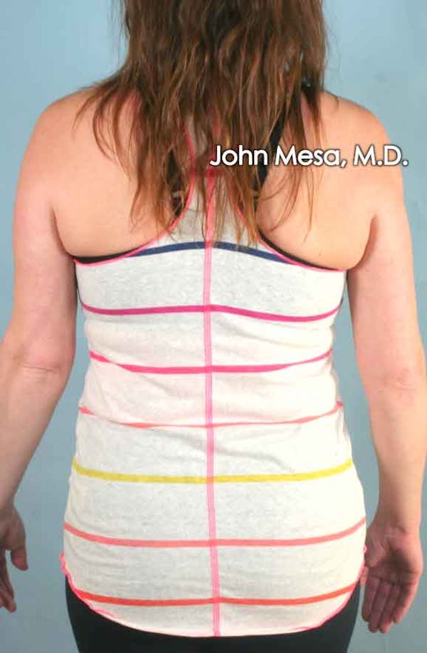Liposuction Before & After Gallery - Patient 6371522 - Image 2
