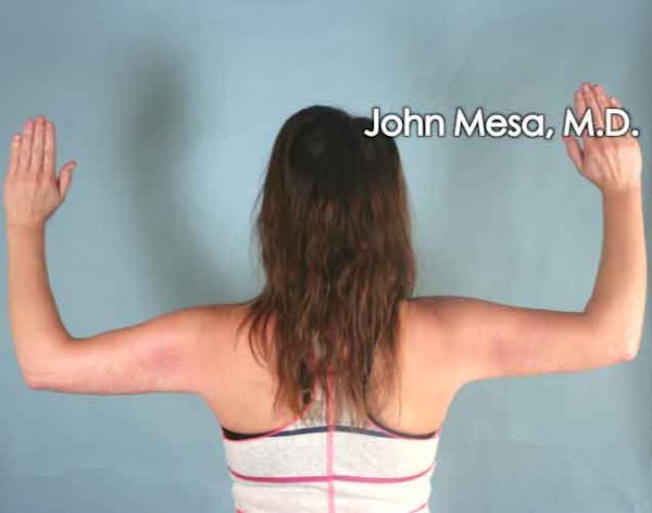 Liposuction Before & After Gallery - Patient 6371522 - Image 4