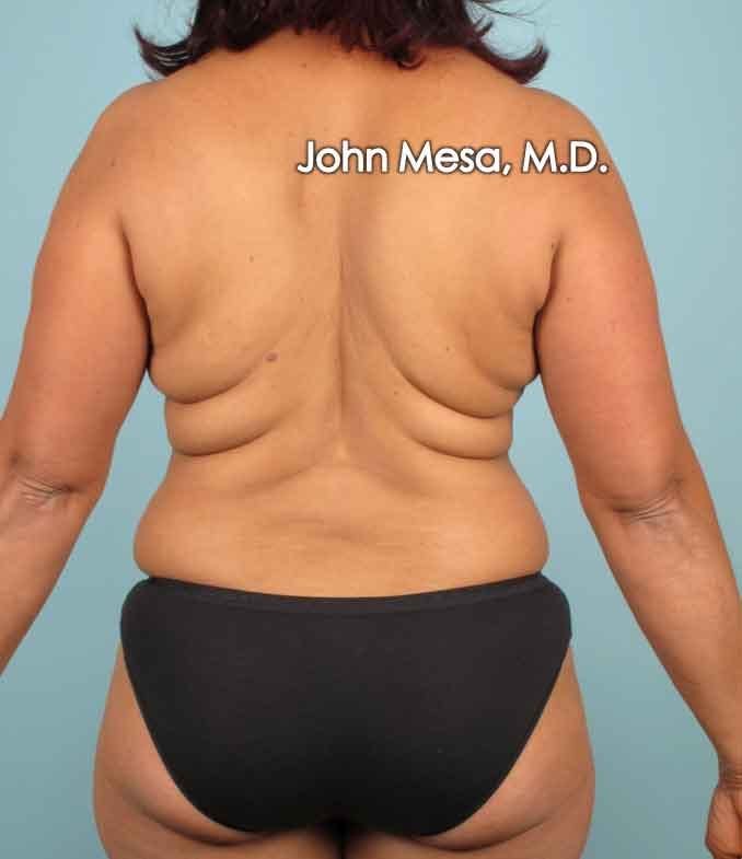 Liposuction Before & After Gallery - Patient 6371523 - Image 1