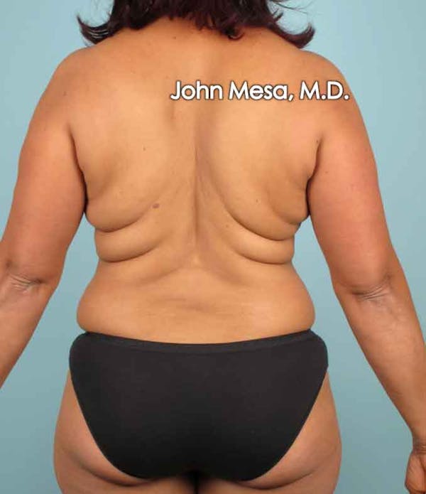 Liposuction Gallery - Patient 6371523 - Image 1
