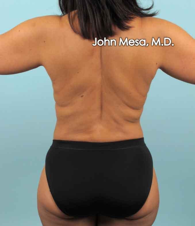 Liposuction Gallery - Patient 6371523 - Image 2