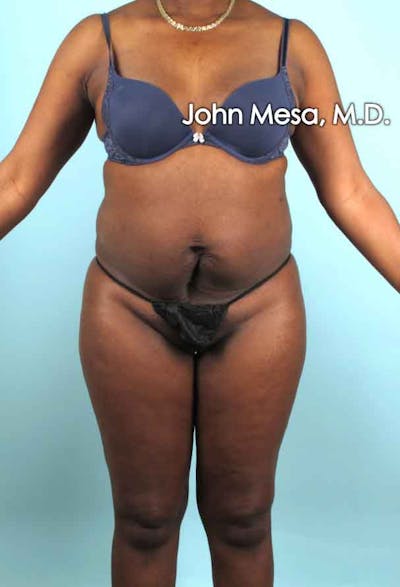 Liposuction Before & After Gallery - Patient 6371524 - Image 1