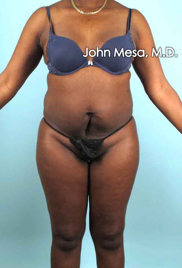Liposuction Before & After Gallery - Patient 6371524 - Image 1