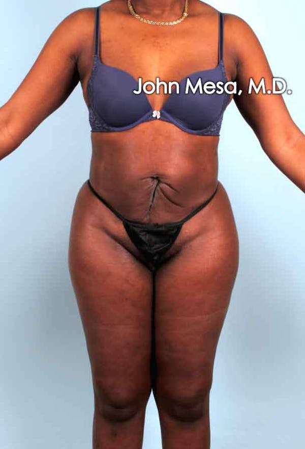 Liposuction Before & After Gallery - Patient 6371524 - Image 2