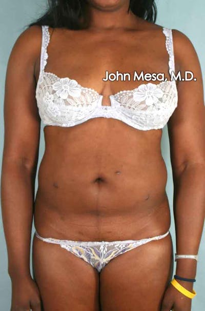 Liposuction Before & After Gallery - Patient 6371525 - Image 1