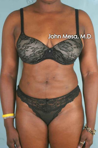 Liposuction Gallery - Patient 6371525 - Image 2