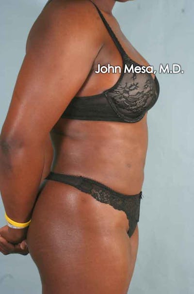 Liposuction Gallery - Patient 6371525 - Image 4