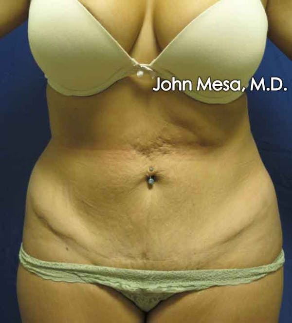 Tummy Tuck Revision Gallery - Patient 6371536 - Image 1
