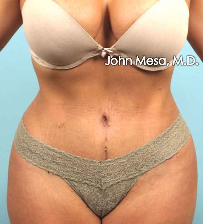 Tummy Tuck Revision Before & After Gallery - Patient 6371536 - Image 2