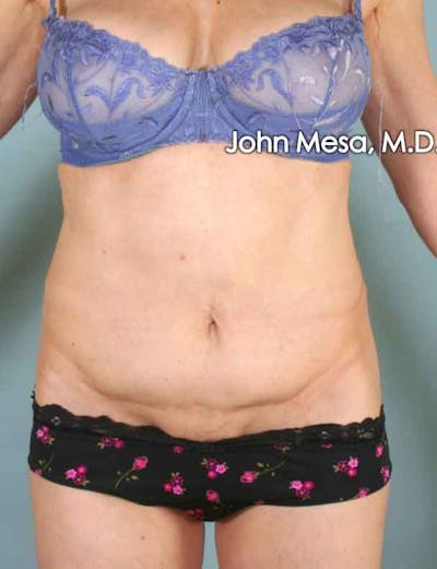 Tummy Tuck Revision Before & After Gallery - Patient 6371538 - Image 1