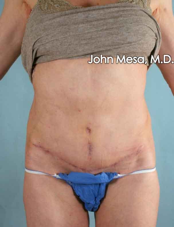 Tummy Tuck Revision Before & After Gallery - Patient 6371538 - Image 2
