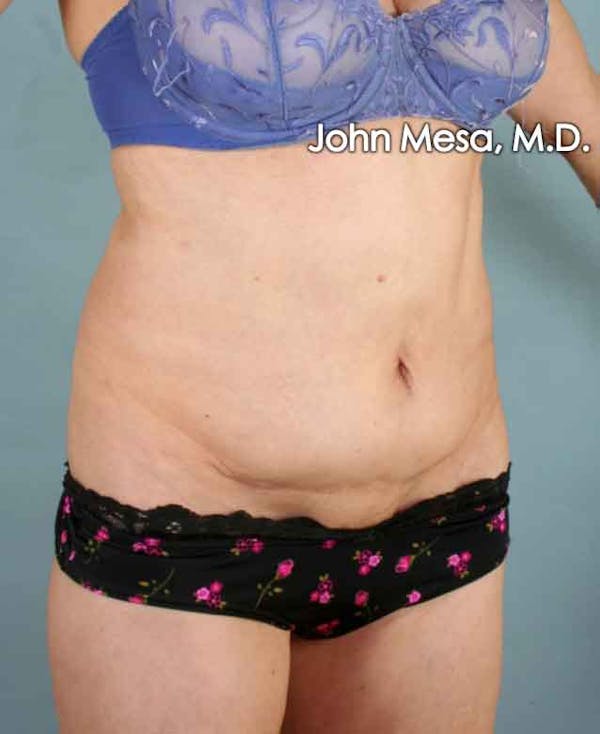 Tummy Tuck Revision Before & After Gallery - Patient 6371538 - Image 3