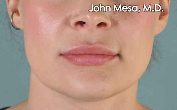 Lip Augmentation (Injectables) Before & After Gallery - Patient 6371540 - Image 1