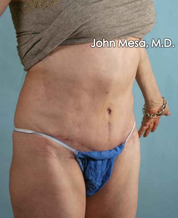 Tummy Tuck Revision Gallery - Patient 6371538 - Image 4