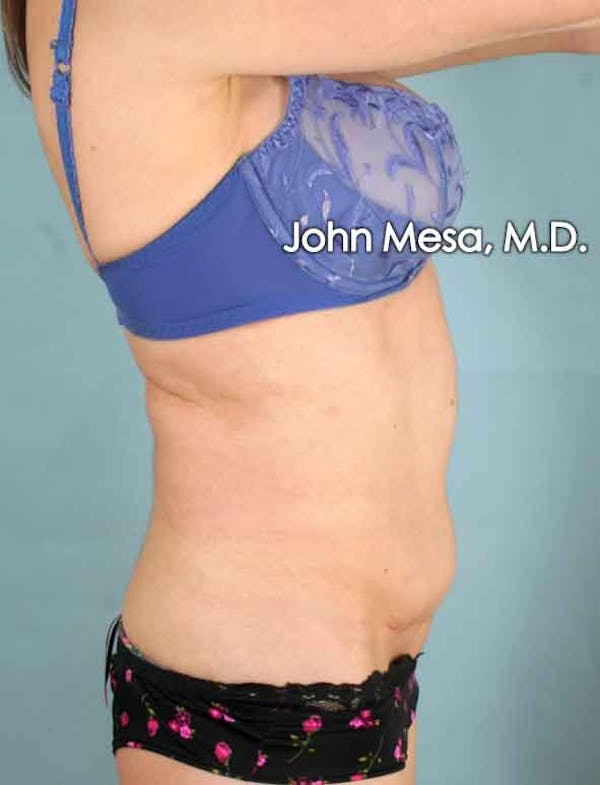 Tummy Tuck Revision Before & After Gallery - Patient 6371538 - Image 5