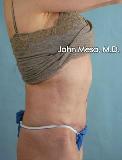 Tummy Tuck Revision Before & After Gallery - Patient 6371538 - Image 6