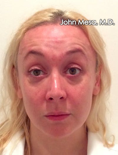 BOTOX Before & After Gallery - Patient 6371562 - Image 1