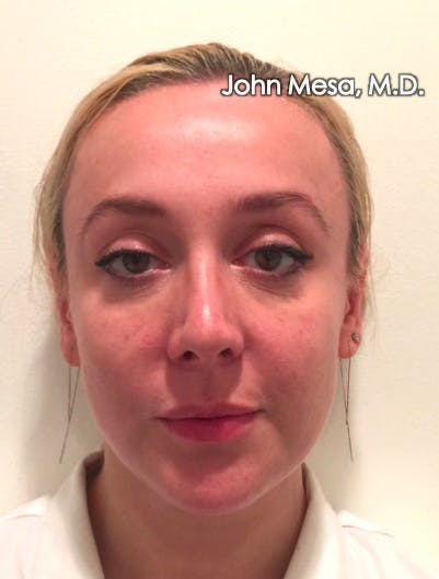 Botox Before & After Gallery - Patient 6371562 - Image 2