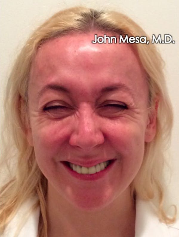 Botox Before & After Gallery - Patient 6371562 - Image 3