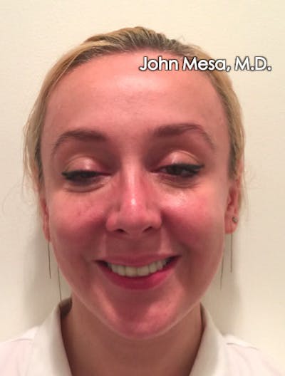 Botox Before & After Gallery - Patient 6371562 - Image 4