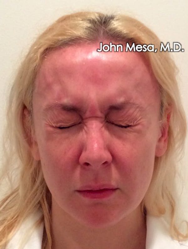 BOTOX Before & After Gallery - Patient 6371562 - Image 5