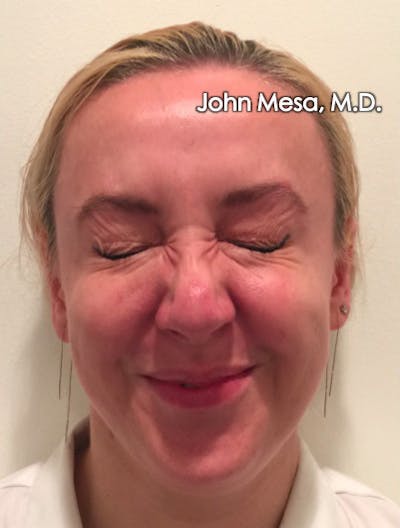 BOTOX Before & After Gallery - Patient 6371562 - Image 6