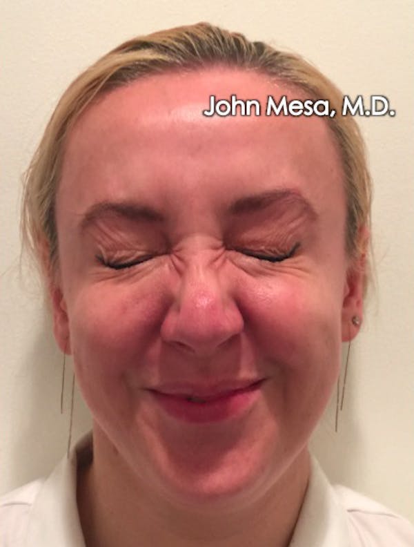 Botox Before & After Gallery - Patient 6371562 - Image 6
