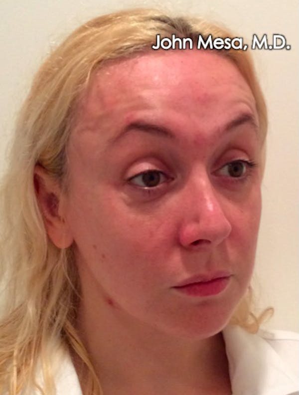 Botox Before & After Gallery - Patient 6371562 - Image 7