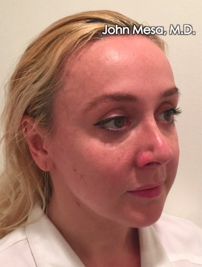 Botox Before & After Gallery - Patient 6371562 - Image 8