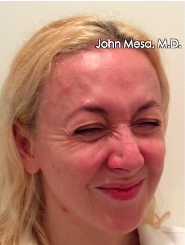 Botox Before & After Gallery - Patient 6371562 - Image 9