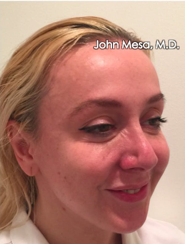 Botox Before & After Gallery - Patient 6371562 - Image 10