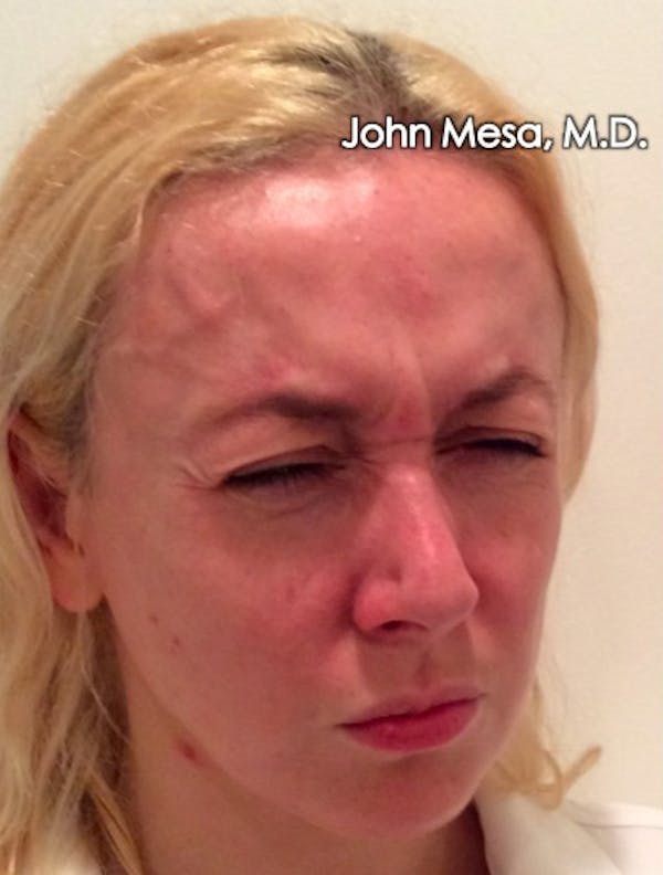 Botox Before & After Gallery - Patient 6371562 - Image 11
