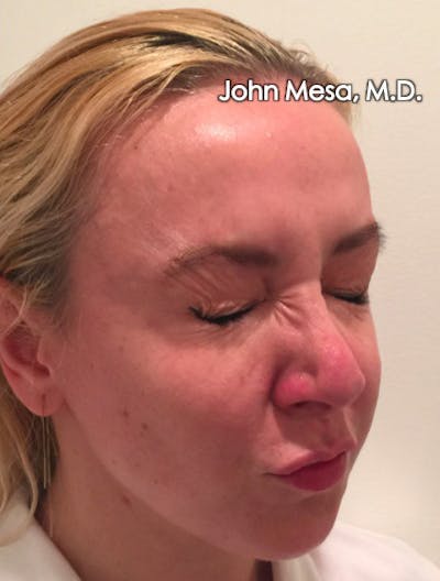 Botox Before & After Gallery - Patient 6371562 - Image 12