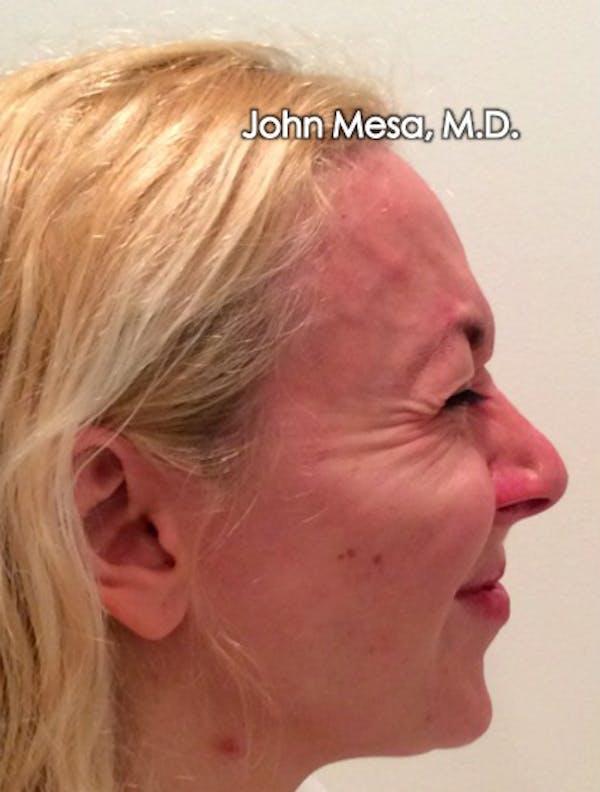Botox Before & After Gallery - Patient 6371562 - Image 13