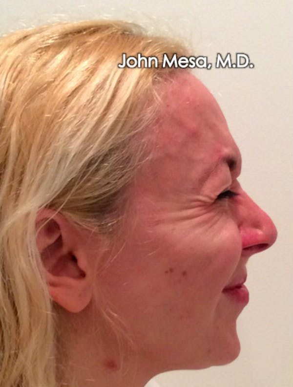 BOTOX Before & After Gallery - Patient 6371562 - Image 13
