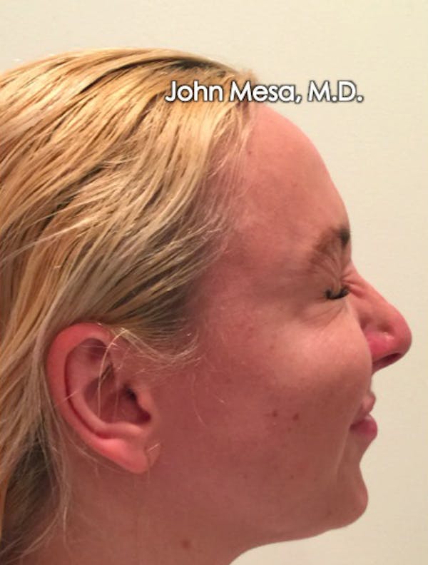 Botox Before & After Gallery - Patient 6371562 - Image 14