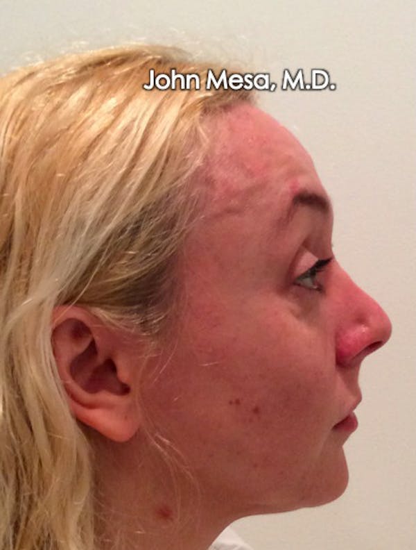 Botox Before & After Gallery - Patient 6371562 - Image 15